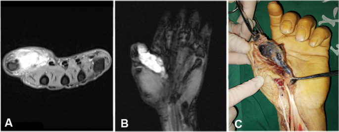 Rare malignant melanotic nerve sheath tumors of the upper limb nerves:  utility of high-frequency ultrasonography in preoperative imaging |  Skeletal Radiology