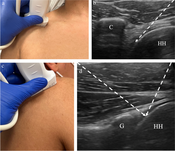 Ultrasound-Guided Injection for Pain Relief