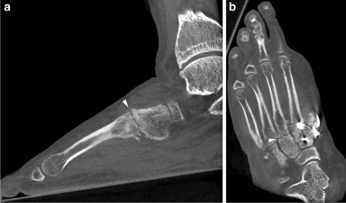 Imaging of osteoarthritis from the ankle through the midfoot