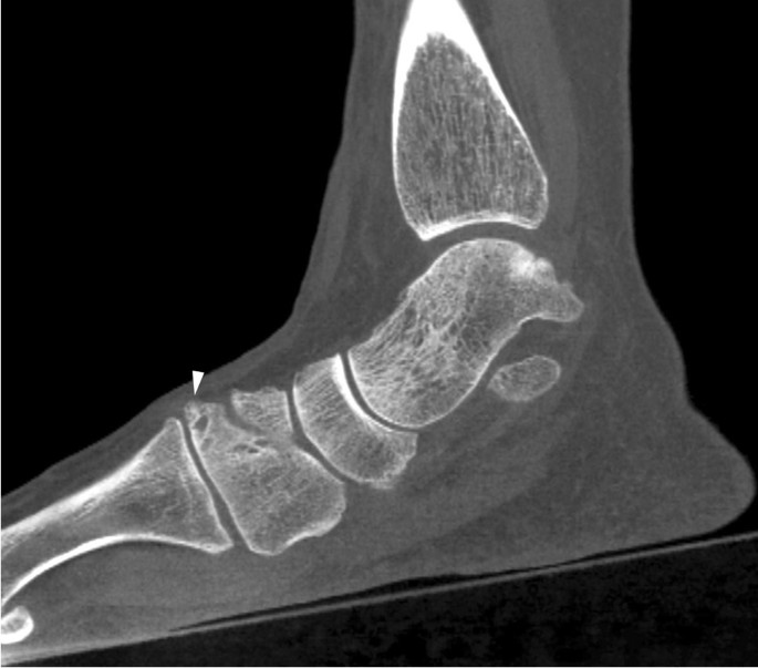 Ball and socket ankle joint, Radiology Reference Article
