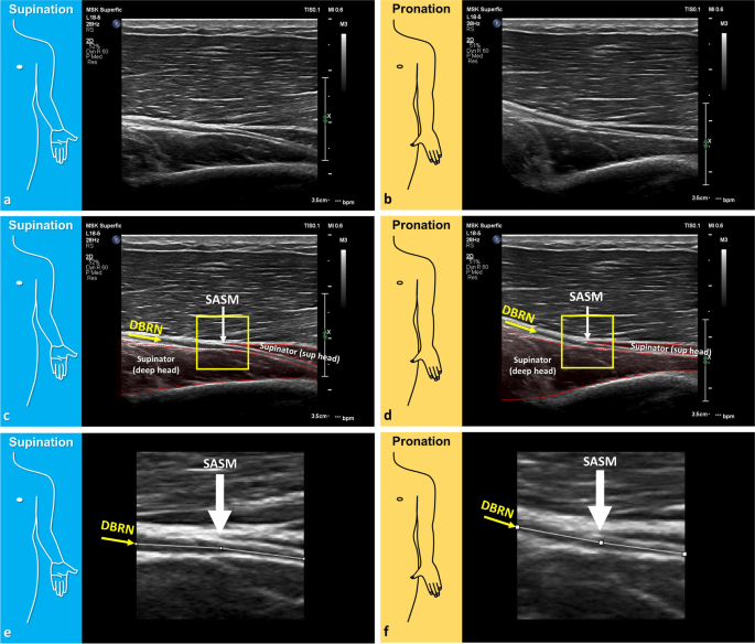 Pronation-supination movement angle.