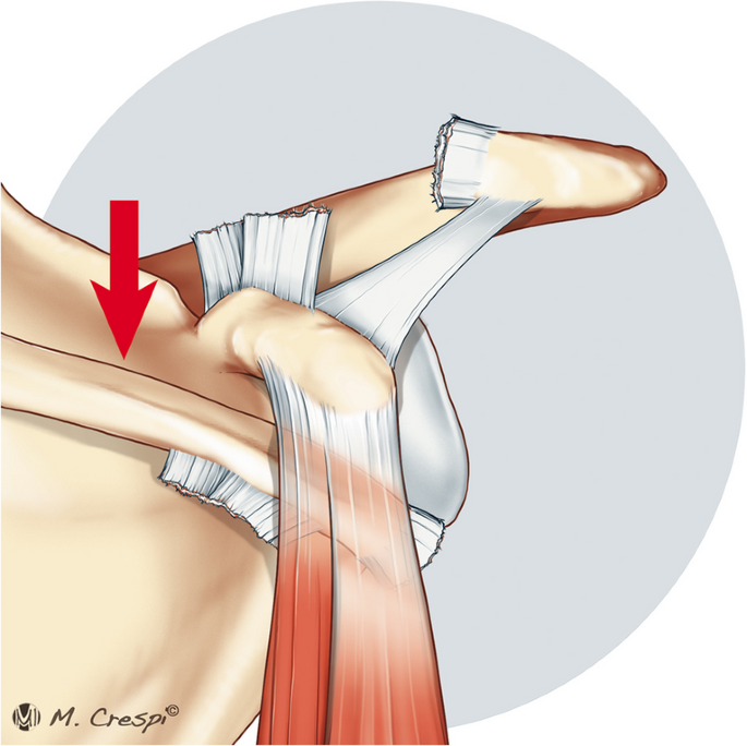 Pectoralis Major Muscle Injuries - Hughston Clinic