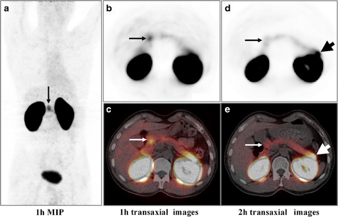 glp-1 pet scan imaging news Brain of the Receptor in Obesity Using 68Ga-NODAGA-Exendin-4 GLP-1 medications are changing the