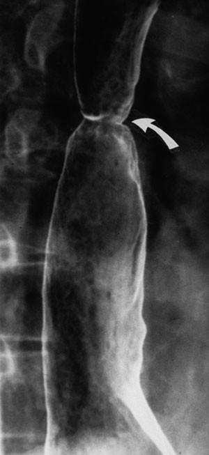 Barrett esophagus: update for radiologists | Abdominal Radiology