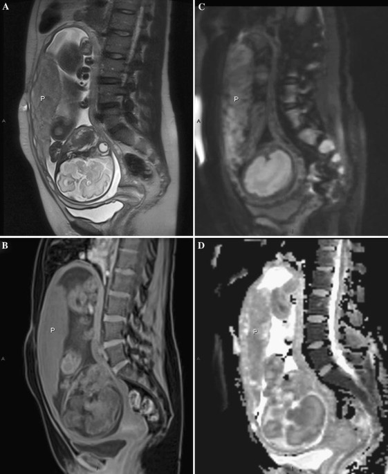 MR imaging of the placenta: what a radiologist should know | Abdominal  Radiology