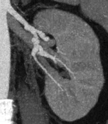 The renal artery string-of-pearls sign | Abdominal Radiology