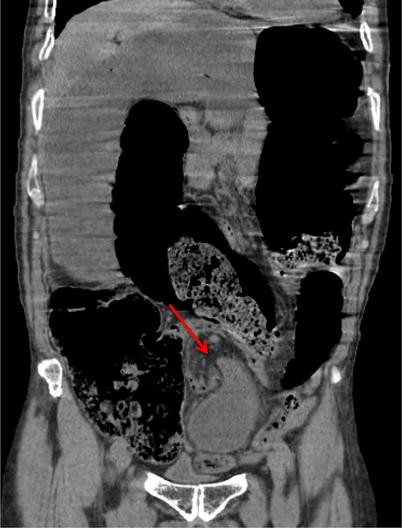 Bird's beak sign | Abdominal Radiology