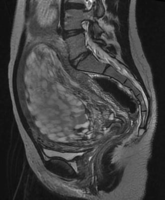 Bunch of grapes” in complete hydatidiform mole | Abdominal Radiology