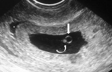 Gestational Sac in Pregnancy and Meaning If Empty