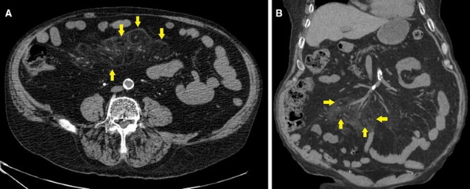 CT A ppearances of A ppendiceal Diseases1