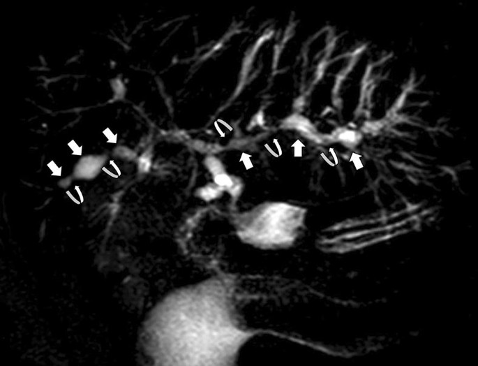 Beaded bile ducts in primary sclerosing cholangitis | Abdominal Radiology