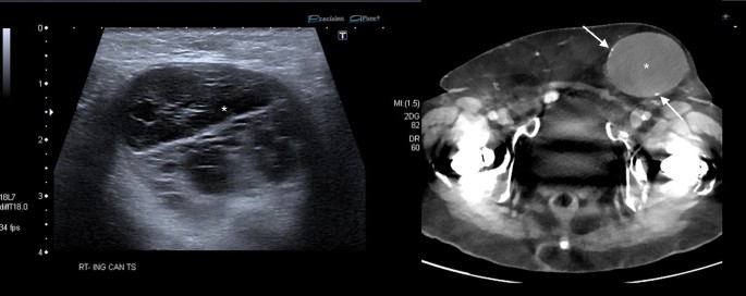 RadioGraphics on X: A groin lump is not uncommon in girls and female  infants. Are you familiar with the US anatomy of the female inguinal canal?  This article reviews US technique and