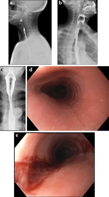 Idiopathic Cervical Esophageal Webs: A Case Report and Literature Revi |  IJGM