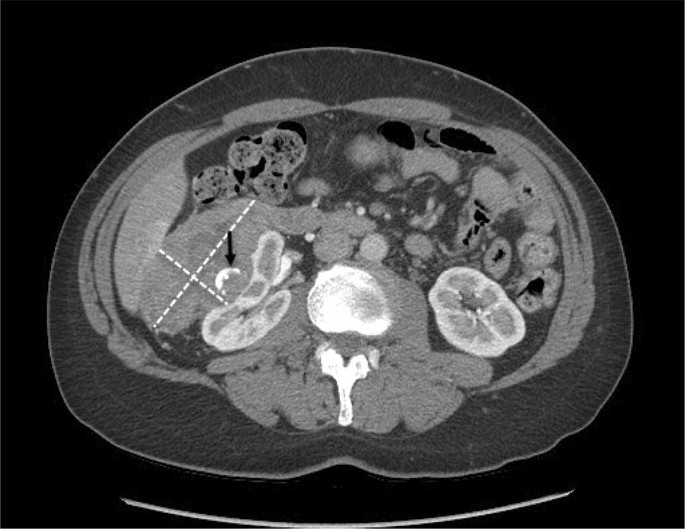 Morison's pouch: anatomical review and evaluation of pathologies and  disease spread on cross-sectional imaging