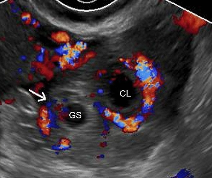 Ruptured Ectopic Pregnancy in the Presence of an Intrauterine Device - The  Western Journal of Emergency Medicine