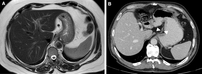 Imaging findings of diseases affecting the gastrohepatic ligament: not as  acquiscent as it seems | Abdominal Radiology