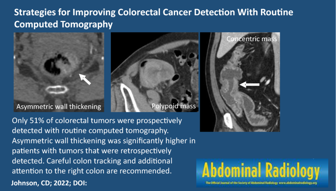 Which Cancers Can a Pelvic CT Scan Detect?
