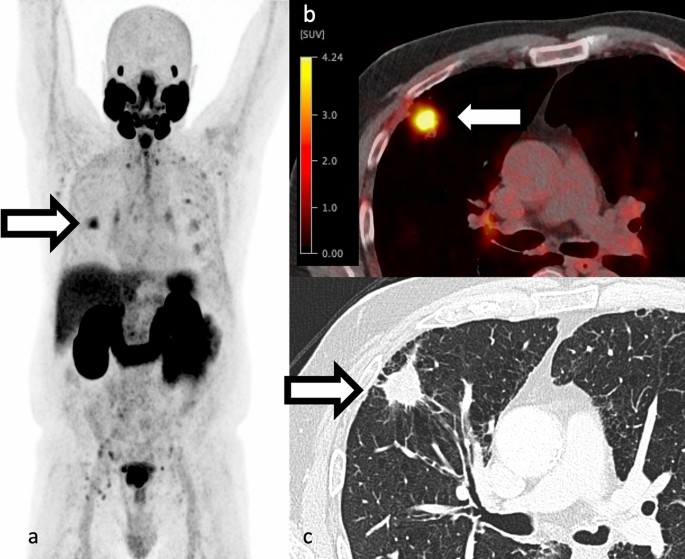 What To Do With a Positive PSMA PET and Negative Conventional Imaging in  Patients With Prostate Cancer