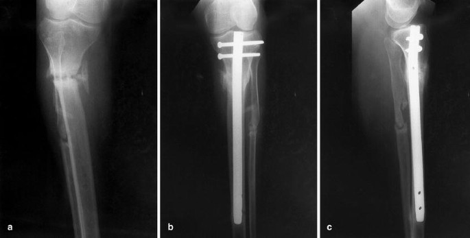 High Value Tibial Nail Utilization Improves Cost Without Compromising  Outcomes: Experience at a Level II Trauma Center | Published in Journal of  Orthopaedic Experience & Innovation