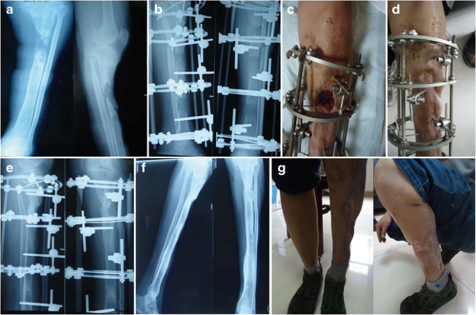 Double-level, proximal-to-distal bone transport using wire fixation. A