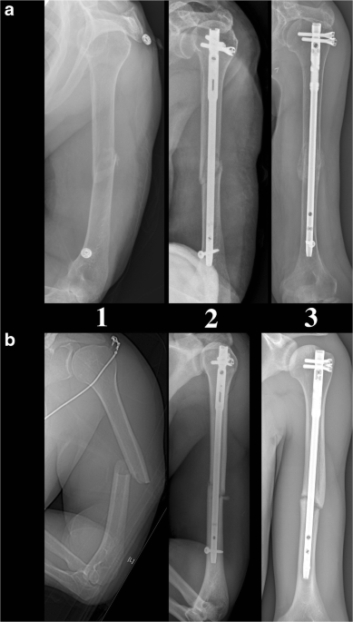 A Retrospective Analysis of Dynamic Compression Plating Versus Intramedullary  Nailing for the Management of Shaft of Humerus Fra