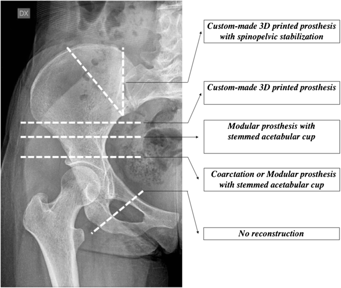Three-dimension-printed custom-made prosthetic reconstructions: from  revision surgery to oncologic reconstructions | International Orthopaedics