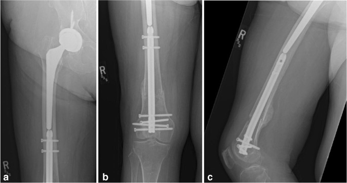 Segmental femoral shaft fracture after car accident. Retrograde nailing...  | Download Scientific Diagram