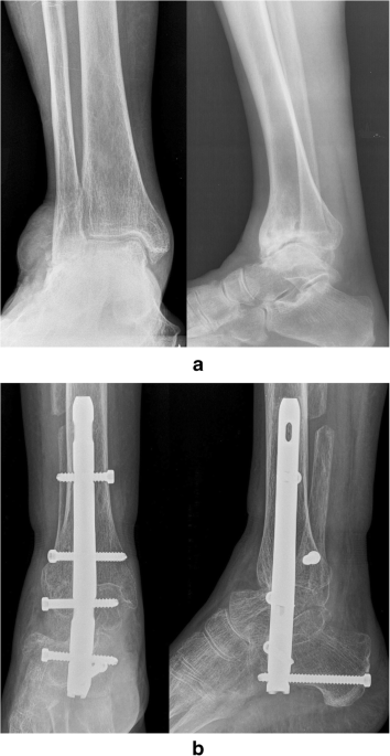 Hindfoot nailing for displaced ankle fractures in the elderly: A  case-control analysis