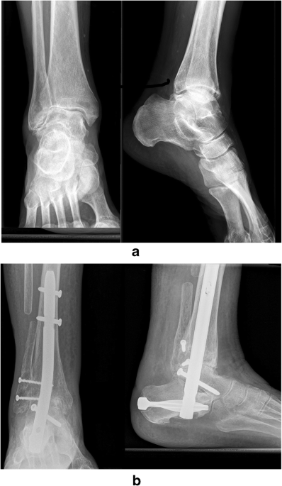 Tibiotalocalcaneal (Hindfoot) Arthrodesis by Retrograde Intramedullary  Nailing Using a Curved Locking Nail. The Results of 52 Procedures |  Semantic Scholar