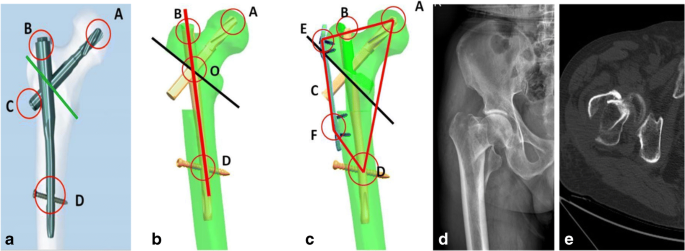 PDF] Biomechanical analysis of femoral fracture fixation using the expert  adolescent lateral femoral nail system | Semantic Scholar