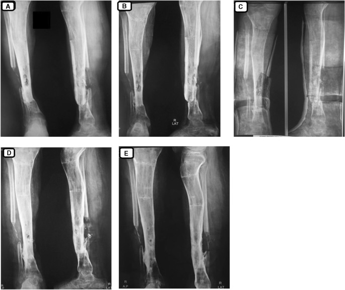 THE MANAGEMENT OF INFECTED NONUNION TIBIA SHAFT WITH ILIZAROV RING