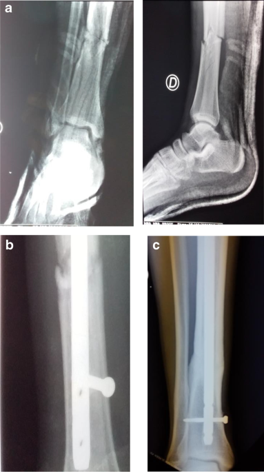 Nailing distal tibial fractures: does entry technique affect distal  alignment? | European Journal of Orthopaedic Surgery & Traumatology