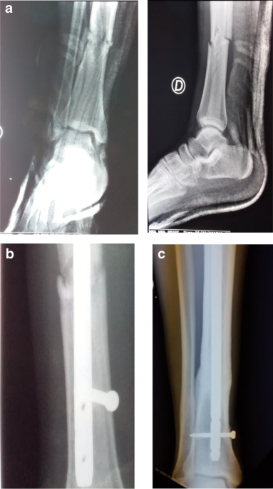 Hot Selling Medic Device Intramedullary Nails Tibia Femur - China Tibial  Interlocking Intramedullary Nail, Interlocking Intramedullary Nail |  Made-in-China.com