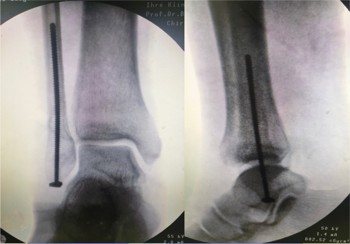 Lateral Malleolar Fracture  Published in Orthopedic Reviews