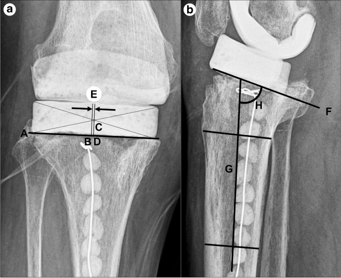 Does spiked tibial cement spacer reduce spacer-related problems in