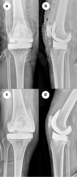 Does spiked tibial cement spacer reduce spacer-related problems in