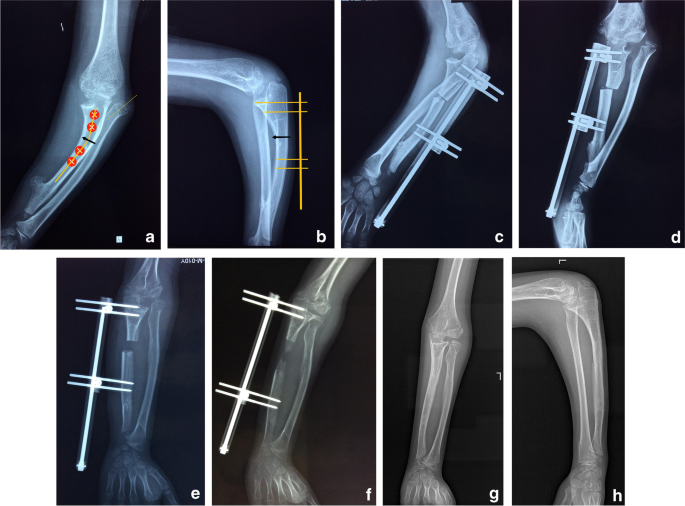 Distraction Osteogenesis Ring System, Products