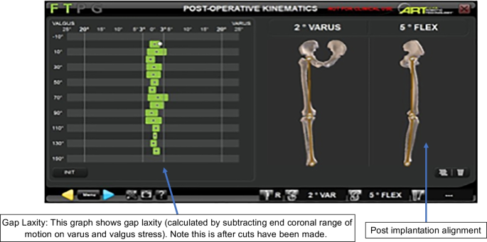 How does the use of quantified gap-balancing affect component positioning  and limb alignment in robotic total knee arthroplasty using functional  alignment philosophy? A comparison of two robotic platforms