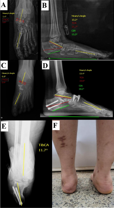 Joint preservation surgery for correcting adolescents' spasmodic flatfoot  deformity: early results from a specialized North African foot and ankle  unit
