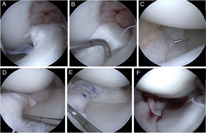 Treatment of chronic and complex meniscal tears with arthroscopic meniscus repair augmented with collagen matrix wrapping: failure rate and functional outcomes | International Orthopaedics