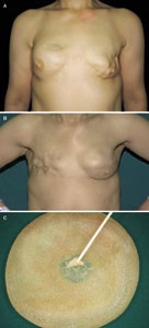 Analysis of 30 Breast Implant Rupture Cases