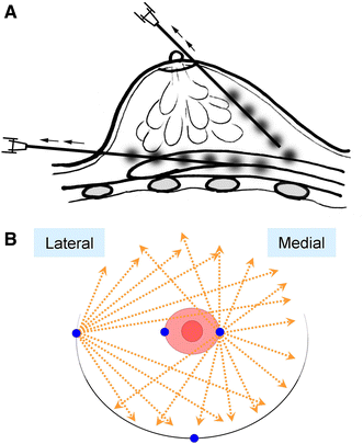 Stem Cell-Enriched Fat Injection in Aesthetic, Reconstructive