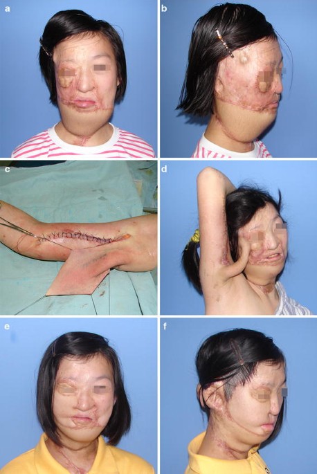 Preexpanded Pedicle Medial Arm Flap: An Alternative Method of Massive  Facial Defect Reconstruction | Aesthetic Plastic Surgery