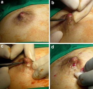 Correction of Inverted Nipple with “Arabesque”-Shape Sutures