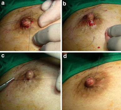 a A temporary-traction 4/0 silk suture is placed to evert the nipple