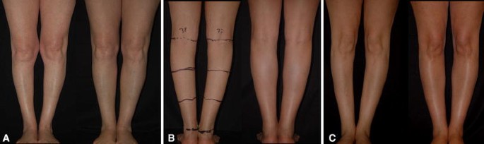 The Benslimane's Artistic Model for Leg Beauty