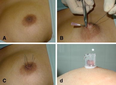 A Minimally Invasive Gradual Traction Technique for Inverted Nipple  Correction
