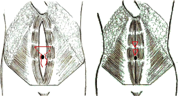 Diastasis recti repair with onlay mesh