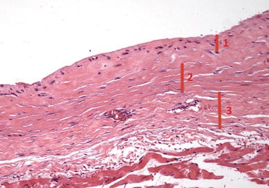 Tension-free capsule-tocapsule closure of the breast implant pocket