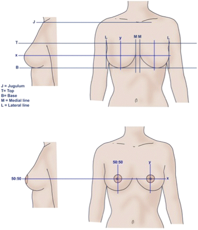 The Aesthetically Ideal Position of the Nipple–Areola Complex on